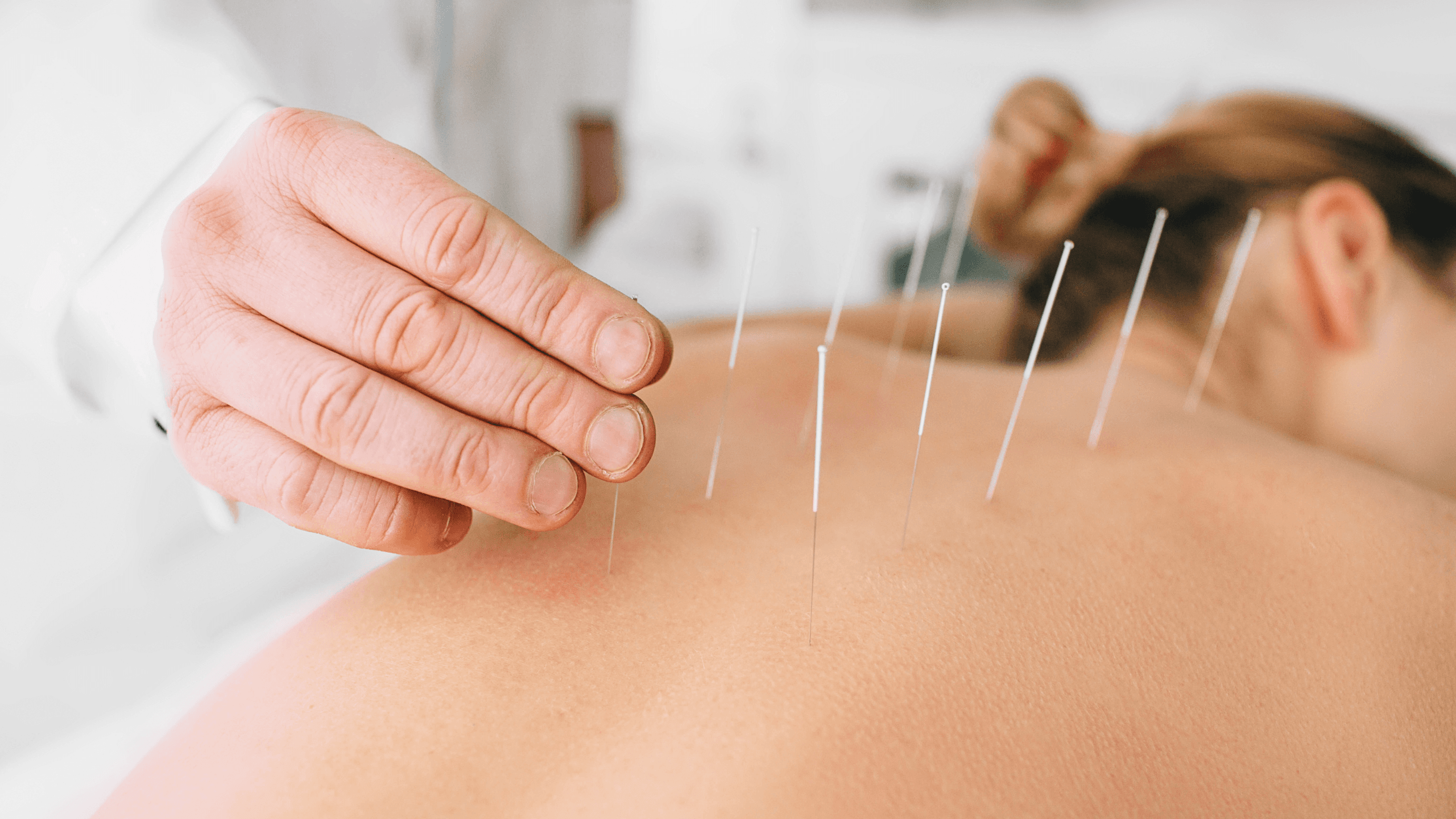 Acupuncture treatment in progress