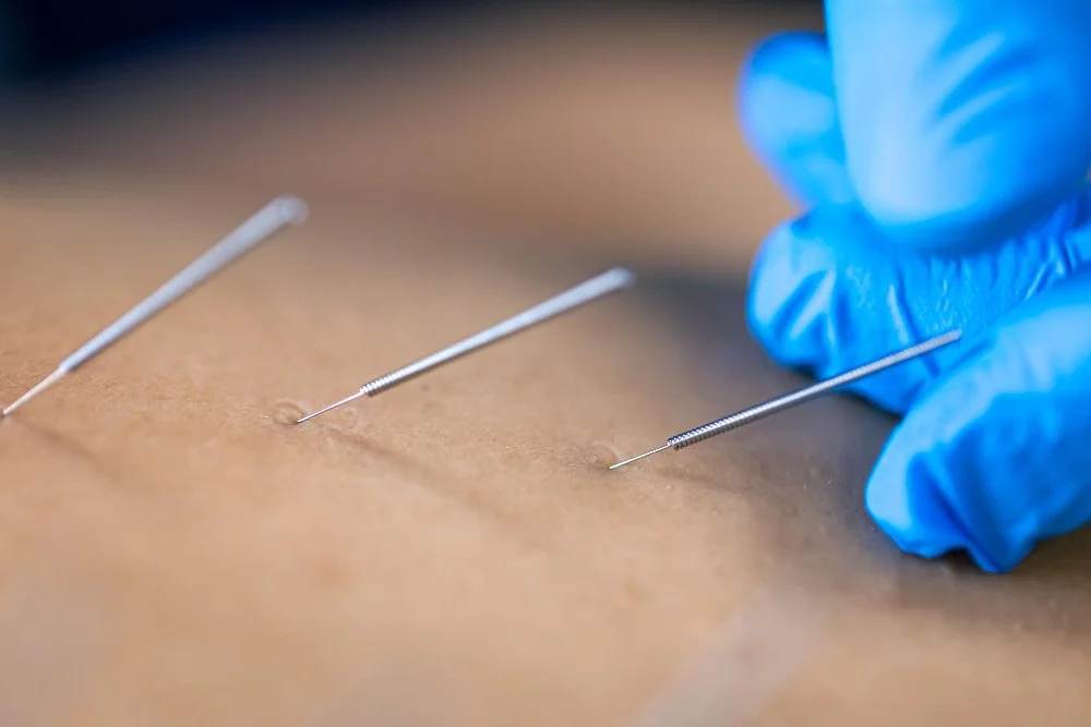 How Cosmetic Acupuncture Refreshes Your Look — Acupuncture Xperts, Boca Raton FL